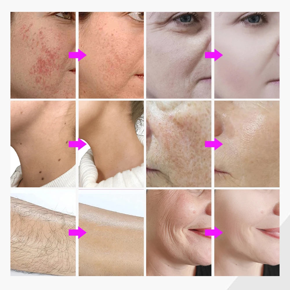 Máquina de Depilación Permanente 5 en 1, Eliminación de Pecas y Lunares, Electrólisis, Depilación Indolora, Depilación de Bikini