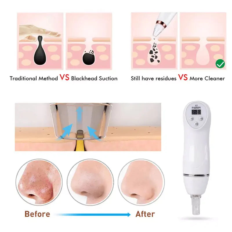 Removedor de Puntos Negros, Limpiador de Poros al Vacío, Succión para Limpieza Facial de Piel Muerta, Exfoliante, Herramienta para Eliminar Acné y Espinillas, Cuidado de la Piel