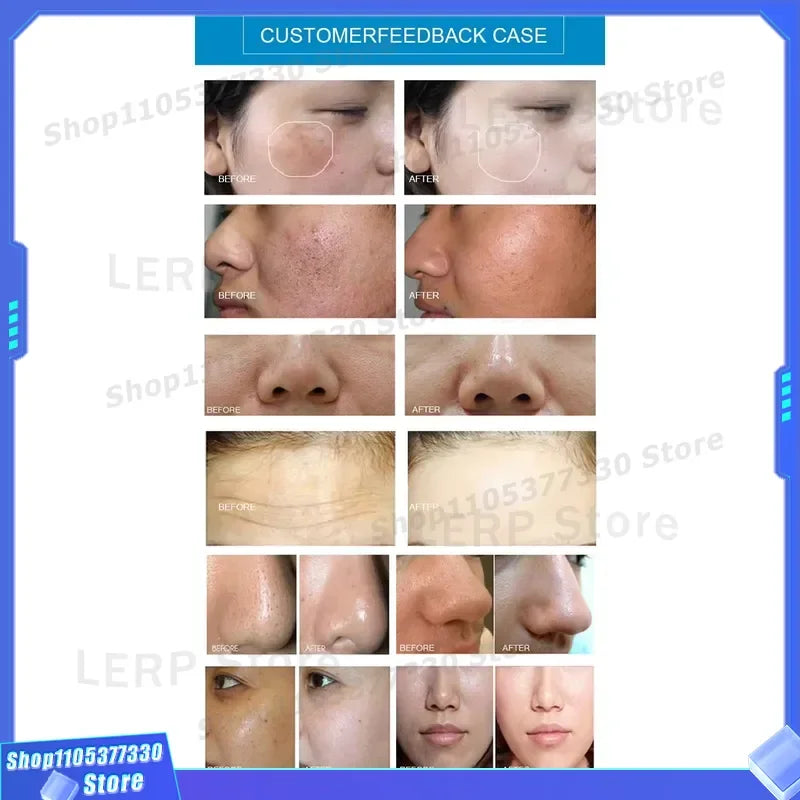 Máscara de Terapia de Luz Roja 5 en 1, Dispositivo de Cuidado Facial, Máquina de Hidrodermoabrasión, Equipo de Belleza para la Limpieza Facial