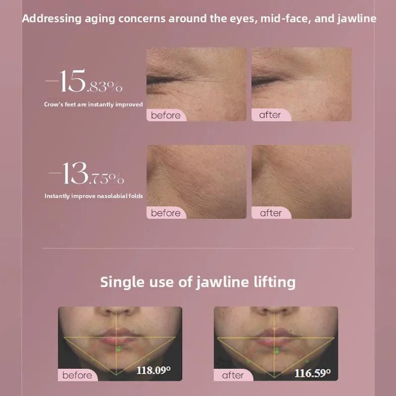 Máquina de Colágeno con Control Inteligente de Matriz de Puntos, Dispositivo de Belleza de Tercera Generación para Tensar los Poros