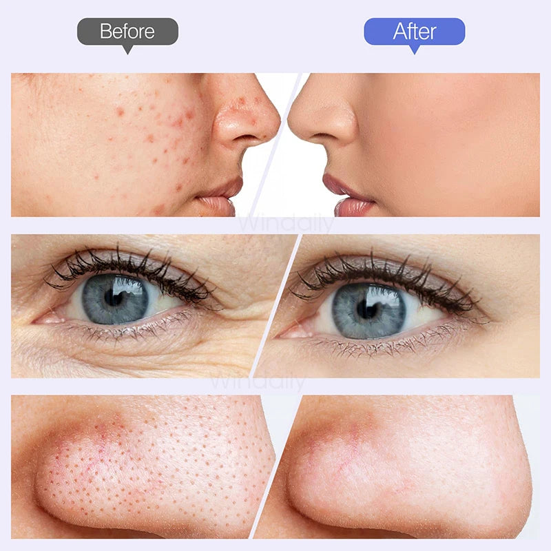 Máquina de microdermoabrasión de diamante inalámbrica 2025, eliminador de espinillas, limpiador de poros al vacío, herramienta de cuidado de la piel Facial, dispositivo de belleza Facial