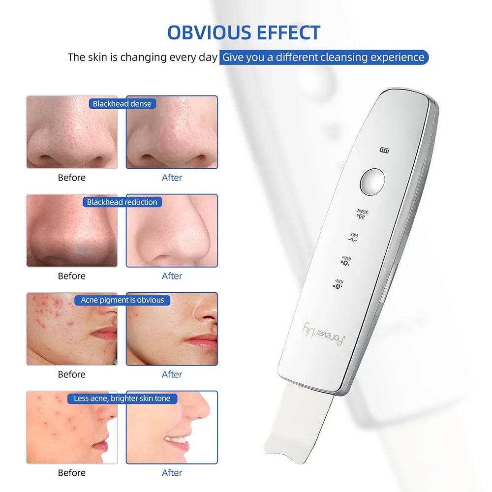 Depurador de piel ultrasónico EMS 6 en 1, masajeador de estiramiento de la piel con fotones LED de iones, espátula Facial, eliminador de espinillas, limpieza Facial profunda