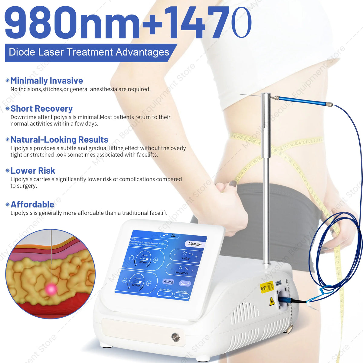 Máquina de lipólisis con endolasa láser 980+1470nm |   Disolución de grasa con fibra óptica, contorno corporal, tensado de la piel, eliminación vascular