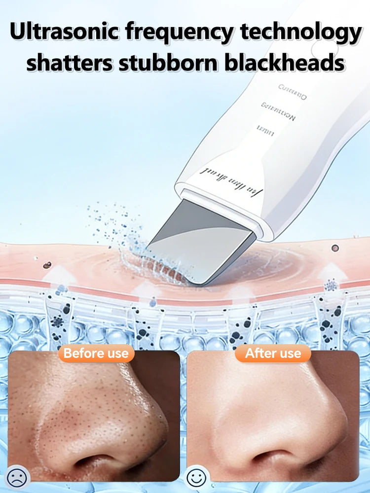 Limpiador Facial Ultrasónico, Removedor de Puntos Negros, Limpiador de Poros Profundos, Exfoliante