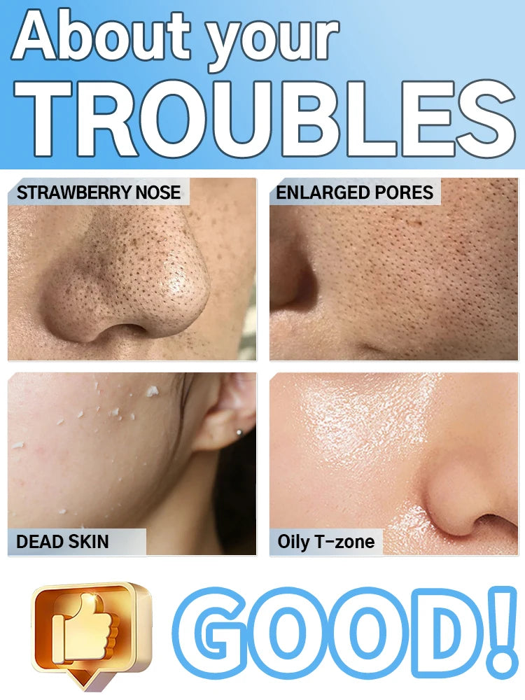 Limpiador Facial Ultrasónico, Removedor de Puntos Negros, Limpiador de Poros Profundos, Exfoliante